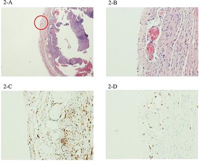 Case report: Histological findings of peri-appendicitis in three children with SARS-CoV-2 – related multisystem inflammatory syndrome: A mark for systemic inflammation?